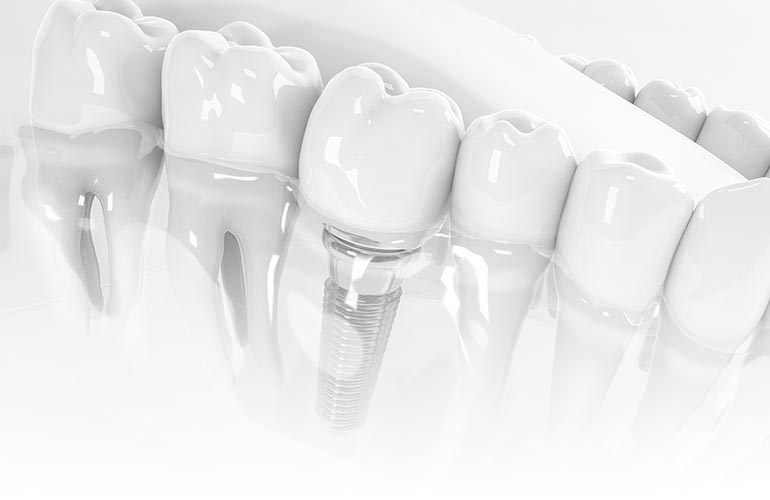Dental implants in Antalya