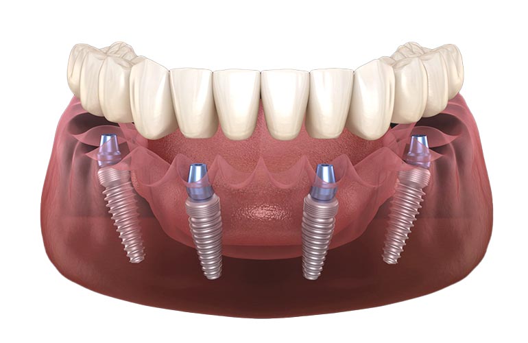 All-on-4 Dental Implants All-on-4 Dental Implants in Antalya