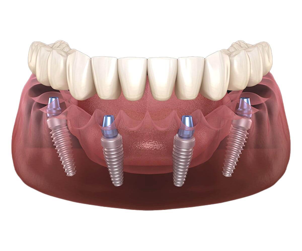 All-on-4 Dental Implants Antalya