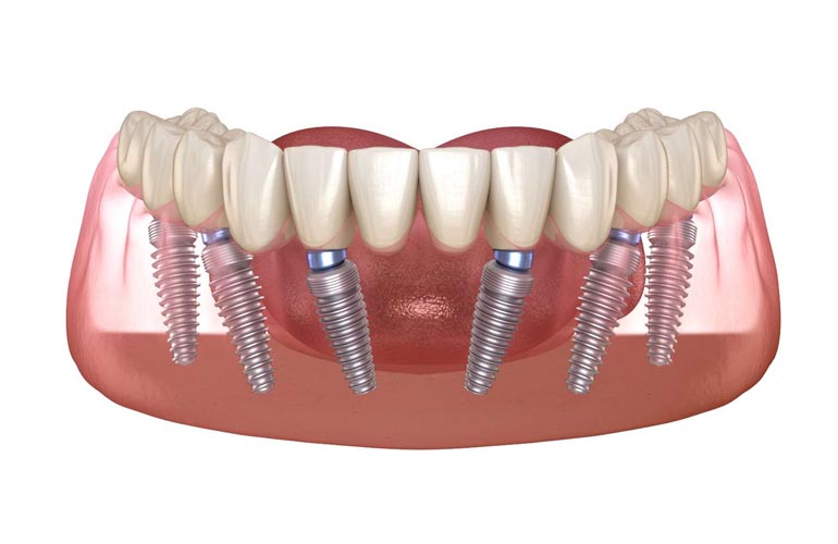 All-on-6 Dental Implants All-on-6 Dental Implants in Antalya