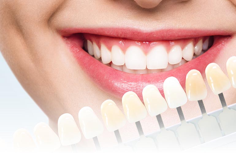 E-Max Crowns E-Max Crowns Antalya